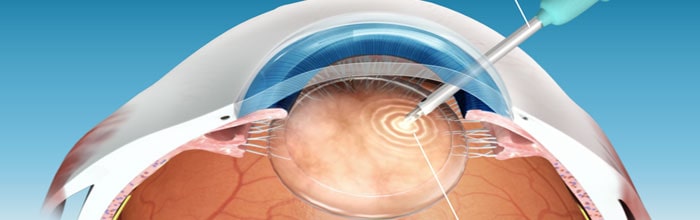 Phacoemulsification